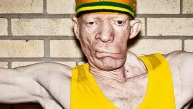 What Happened To King Yellowman's Face? Is He Still Alive?