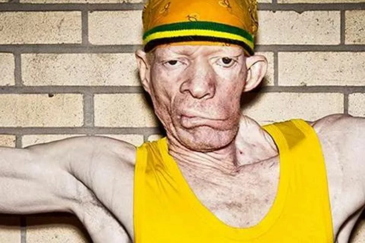 What Happened To King Yellowman's Face? Is He Still Alive?